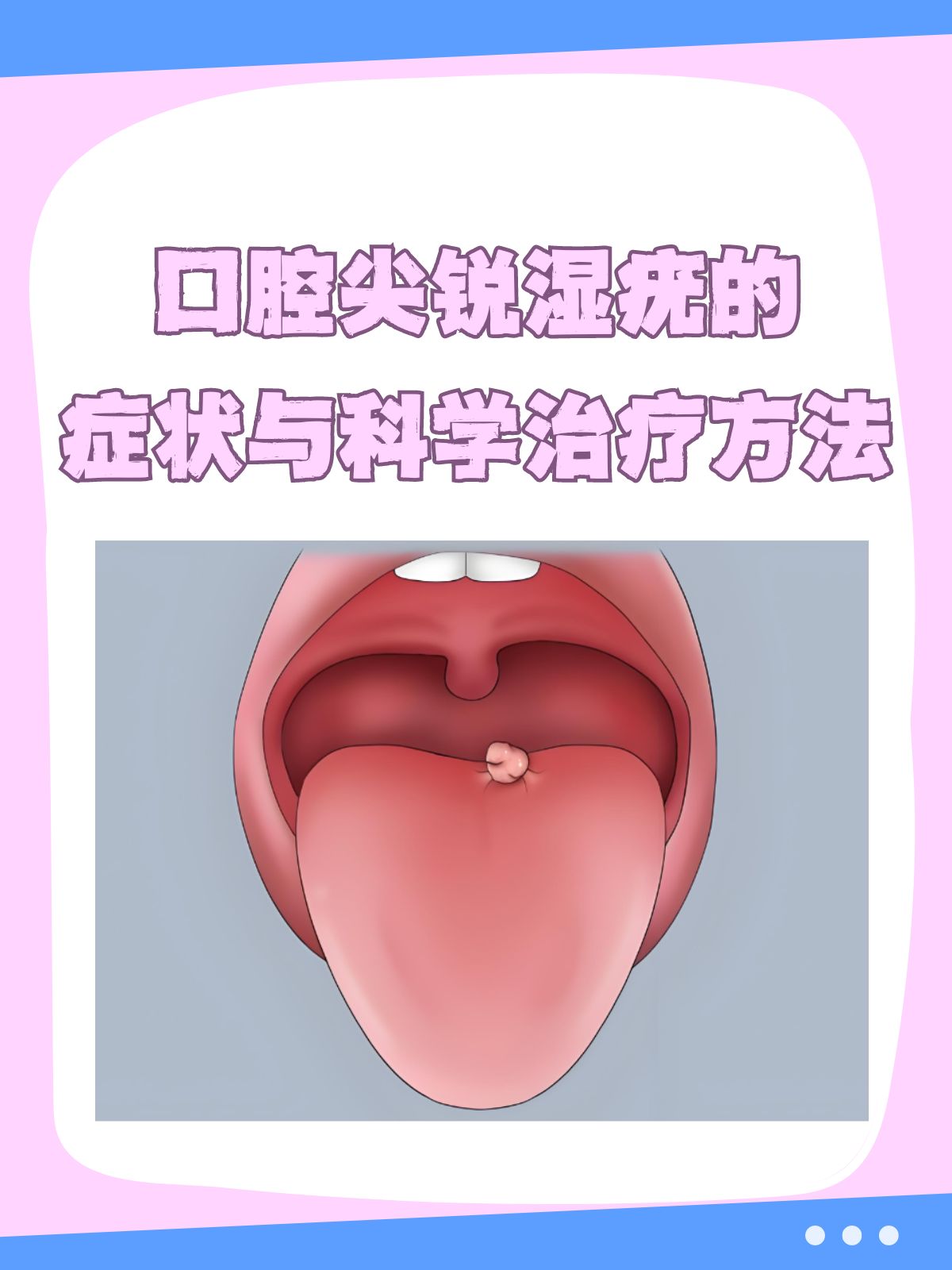 尖锐湿疣怎么治疗才能根治口腔_(尖锐湿疣怎么治疗才能根治口腔溃疡)